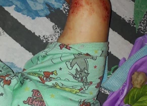 Lagoa Formosa: Secretaria de Saúde esclarece sobre tratamento de garotinho com dermatite 