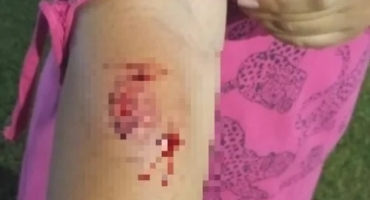 Mulher é atacada por cão da raça pitbull enquanto passeava com o filho de um ano; em Patos de Minas Mulher é atacada por cão da raça pitbull enquanto passeava com o filho de um ano; em Patos de Minas
