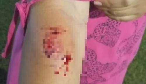Mulher é atacada por cão da raça pitbull enquanto passeava com o filho de um ano; em Patos de Minas 