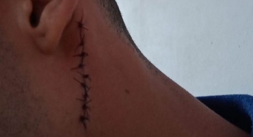 Lagoa Formosa - Rapaz de 25 anos é atingido por golpe de facão no pescoço após desentendimento por causa de dois pedaços de madeira Lagoa Formosa - Rapaz de 25 anos é atingido por golpe de facão no pescoço após desentendimento por causa de dois pedaços de madeira